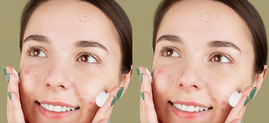 removing the blemishes 